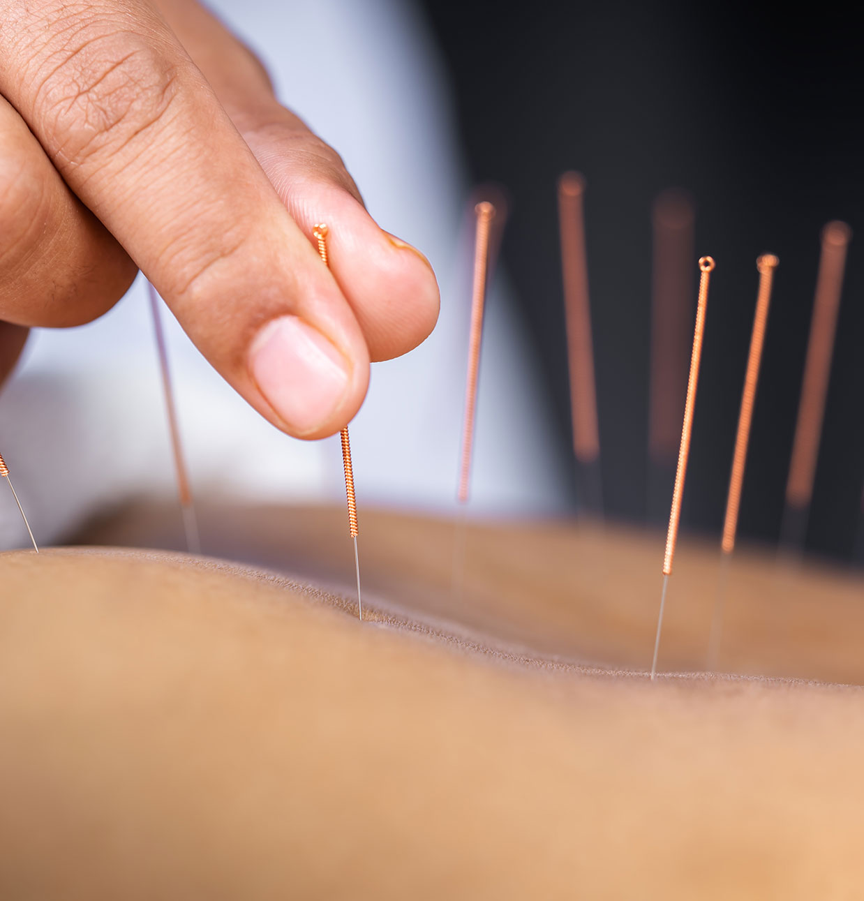 Acupuncture